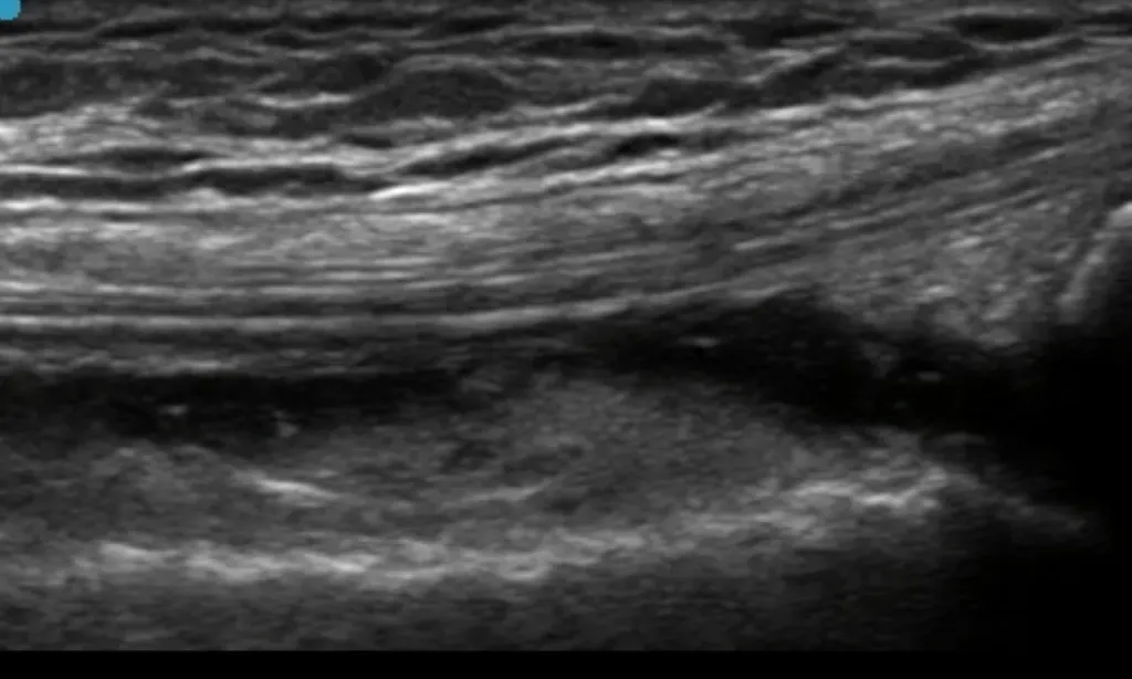 Close up of a knee ultrasound